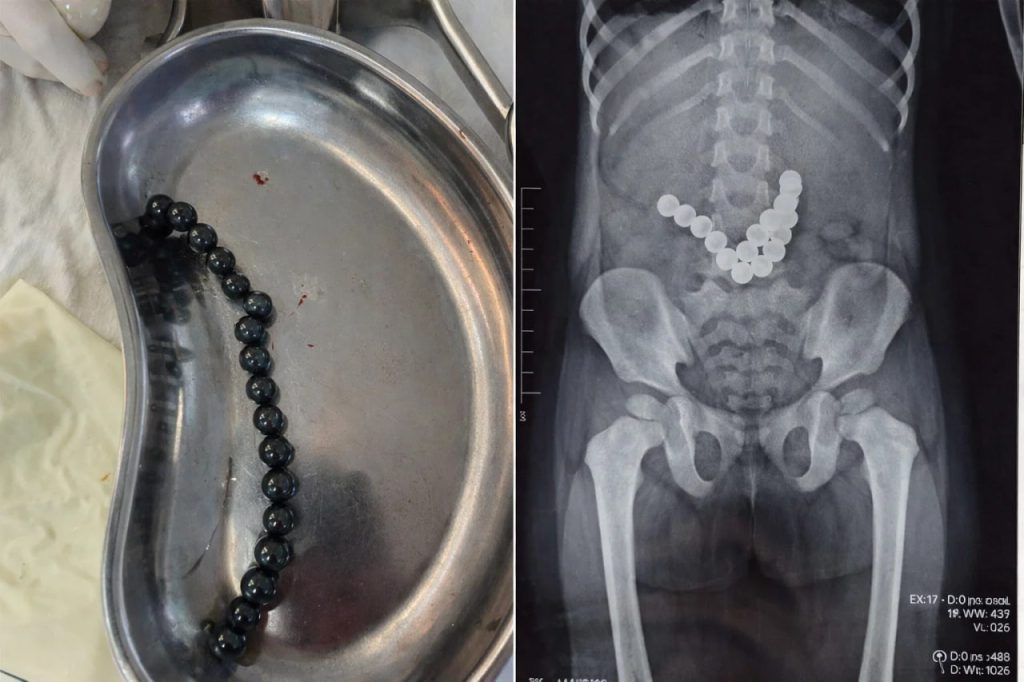 В Оше врачи спасли ребенка, проглотившего 17 магнитов